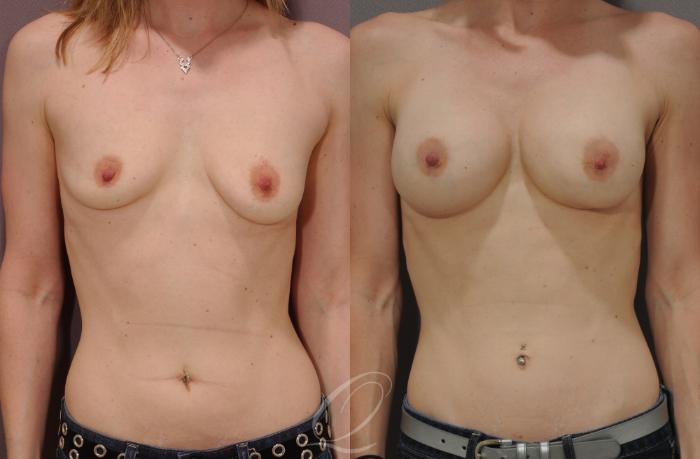 Breast Augmentation Case 1081 Before & After View #1 | Serving Rochester, Syracuse & Buffalo, NY | Quatela Center for Plastic Surgery