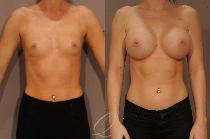 Breast Augmentation Case 1104 Before & After View #1 | Serving Rochester, Syracuse & Buffalo, NY | Quatela Center for Plastic Surgery
