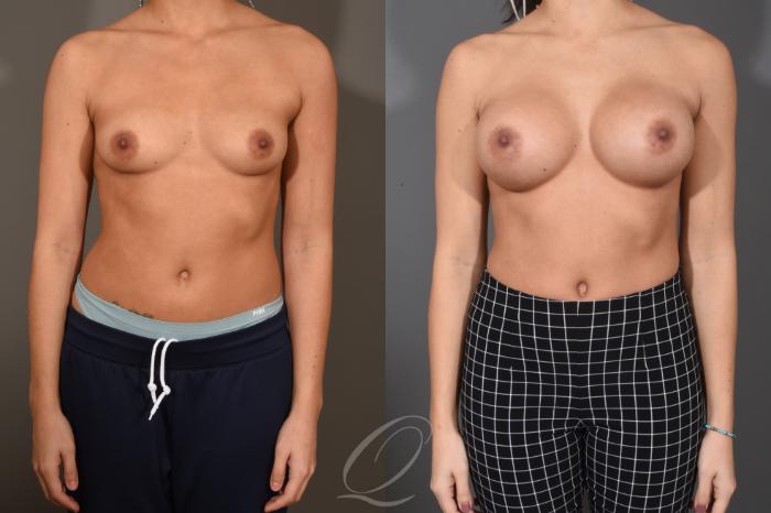 Breast Augmentation Case 1486 Before & After Front | Serving Rochester, Syracuse & Buffalo, NY | Quatela Center for Plastic Surgery