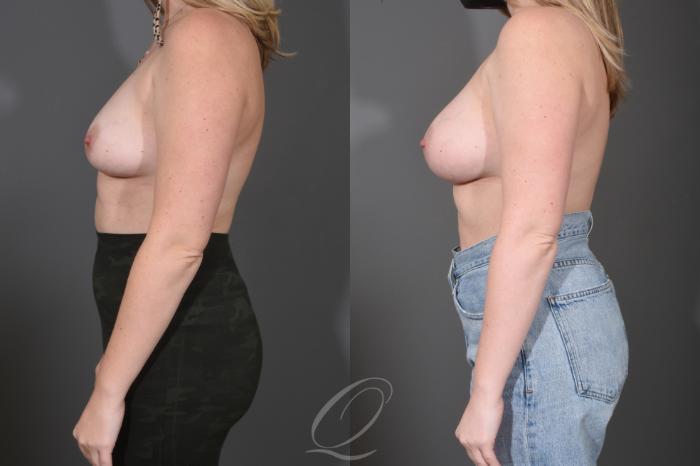 Breast Augmentation Case 1487 Before & After Left Side | Serving Rochester, Syracuse & Buffalo, NY | Quatela Center for Plastic Surgery