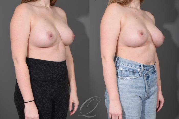 Breast Augmentation Case 1487 Before & After Right Oblique | Serving Rochester, Syracuse & Buffalo, NY | Quatela Center for Plastic Surgery