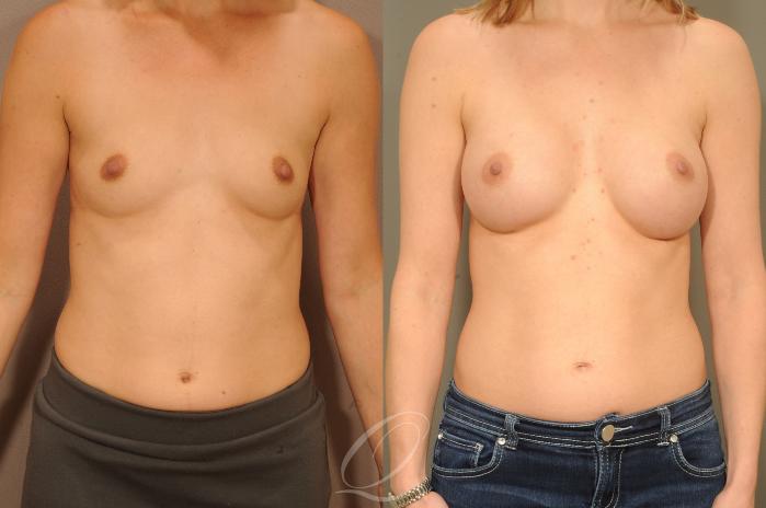 Breast Augmentation Case 300 Before & After View #1 | Serving Rochester, Syracuse & Buffalo, NY | Quatela Center for Plastic Surgery