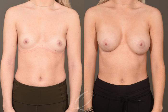 Breast Augmentation Case 419 Before & After Front | Serving Rochester, Syracuse & Buffalo, NY | Quatela Center for Plastic Surgery