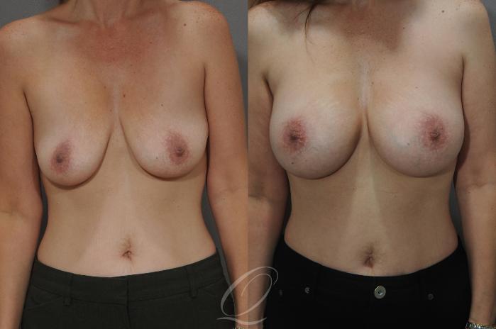 Breast Augmentation Case 8 Before & After View #1 | Serving Rochester, Syracuse & Buffalo, NY | Quatela Center for Plastic Surgery