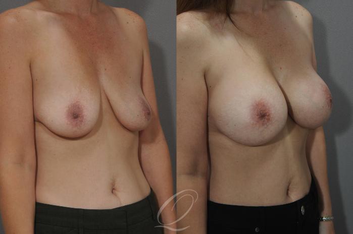 Breast Augmentation Case 8 Before & After View #2 | Serving Rochester, Syracuse & Buffalo, NY | Quatela Center for Plastic Surgery