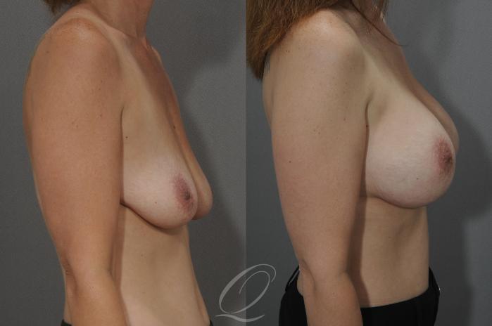 Breast Augmentation Case 8 Before & After View #3 | Serving Rochester, Syracuse & Buffalo, NY | Quatela Center for Plastic Surgery