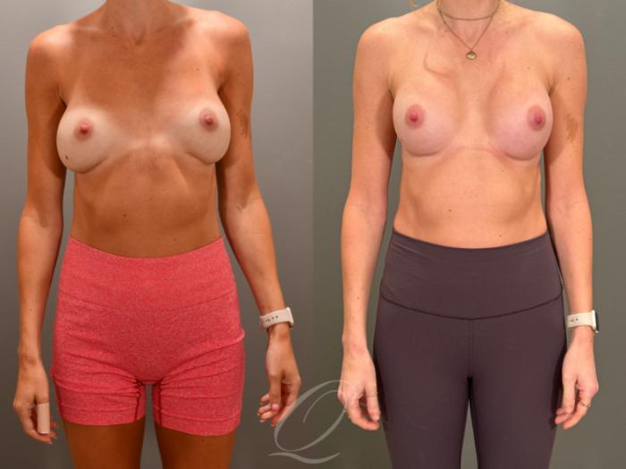 Breast Augmentation Revision Case 1001853 Before & After Front | Serving Rochester, Syracuse & Buffalo, NY | Quatela Center for Plastic Surgery