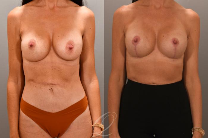 Breast Augmentation Revision Case 1001868 Before & After Front | Serving Rochester, Syracuse & Buffalo, NY | Quatela Center for Plastic Surgery