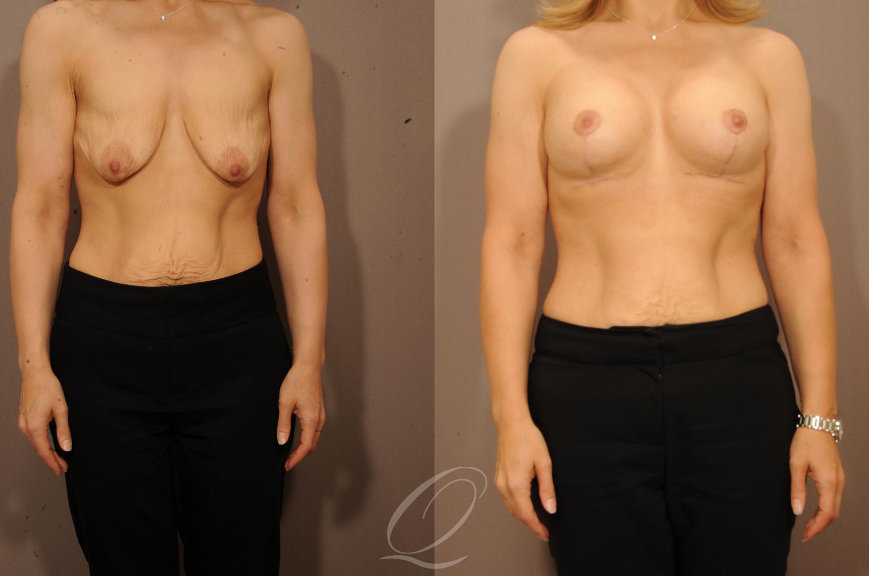 Breast Augmentation with Lift Case 1130 Before & After View #1 | Rochester, NY | Quatela Center for Plastic Surgery