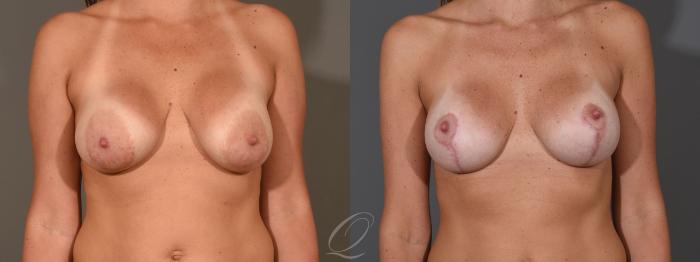Breast Augmentation with Lift Case 1398 Before & After Front | Serving Rochester, Syracuse & Buffalo, NY | Quatela Center for Plastic Surgery