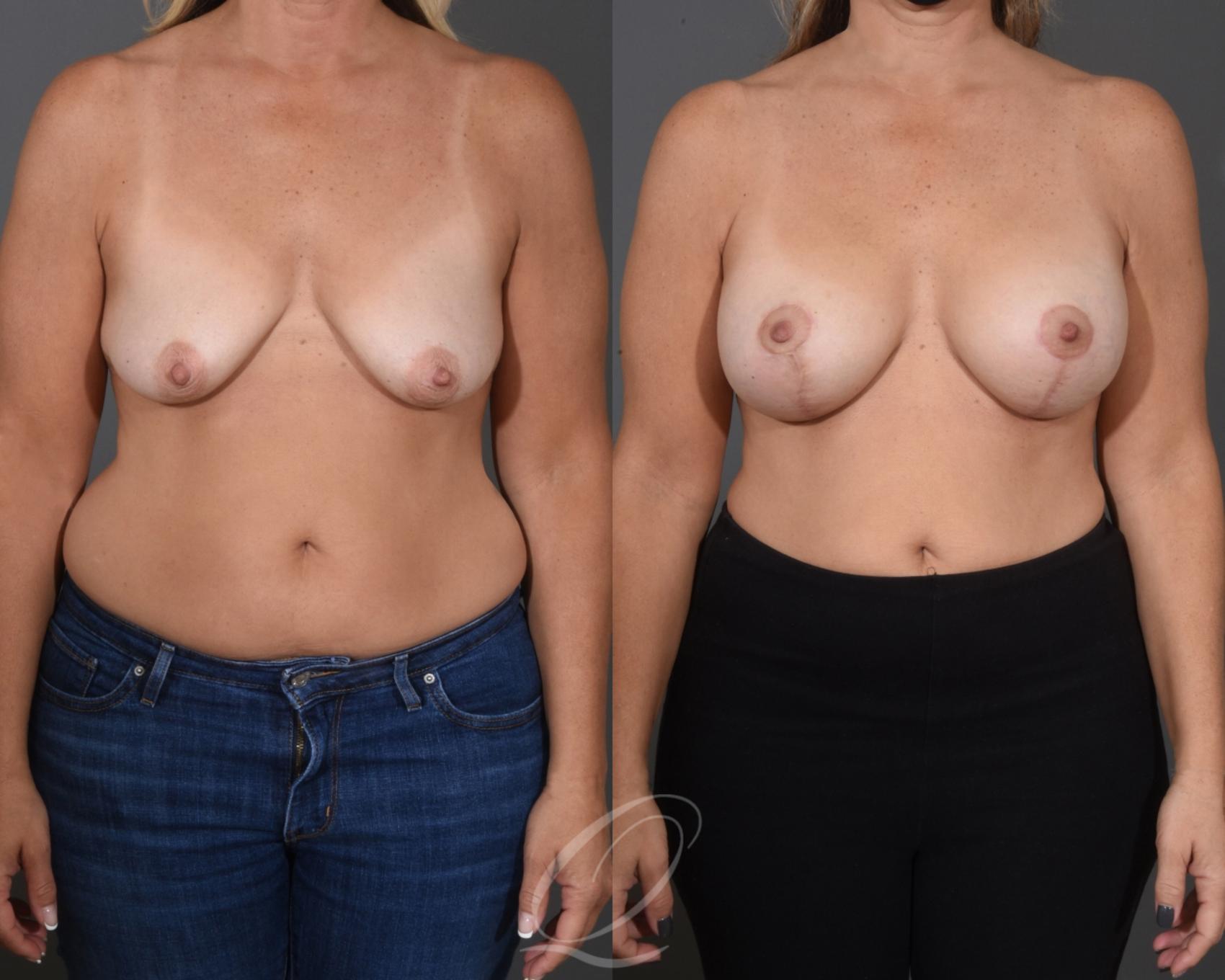 Breast Augmentation with Lift Case 1474 Before & After Front | Serving Rochester, Syracuse & Buffalo, NY | Quatela Center for Plastic Surgery
