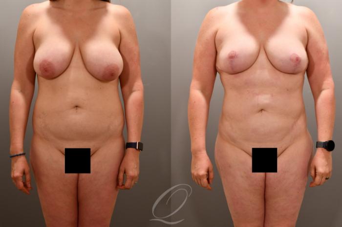 Renuvion Skin Tightening Treatment Case 1001865 Before & After Front | Serving Rochester, Syracuse & Buffalo, NY | Quatela Center for Plastic Surgery
