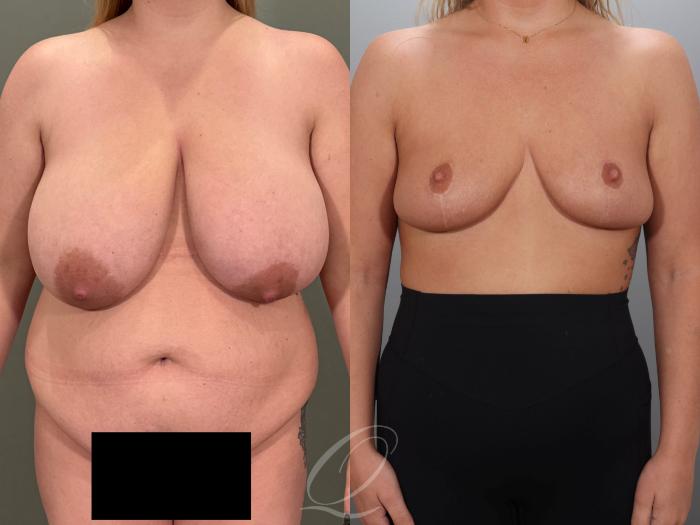 Breast Reduction Case 1001989 Before & After Front | Serving Rochester, Syracuse & Buffalo, NY | Quatela Center for Plastic Surgery