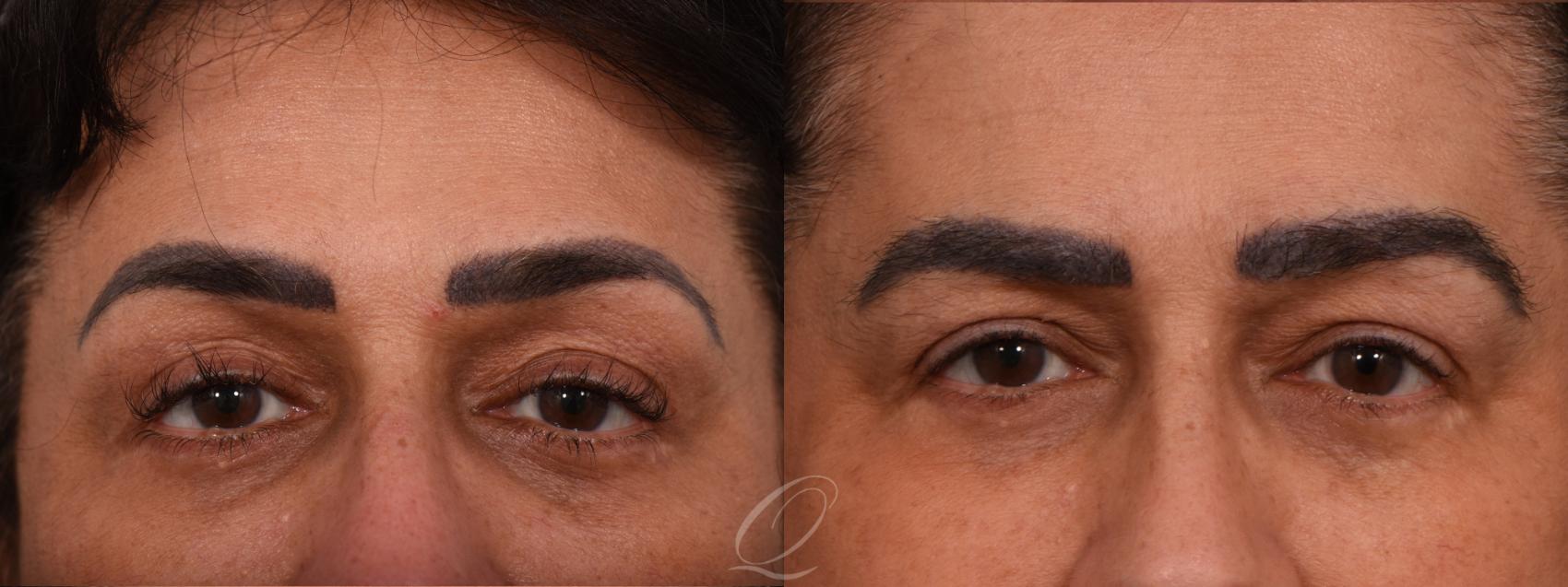Eyebrow Hair Transplant Case 1001678 Before & After Front | Rochester, Buffalo, & Syracuse, NY | Quatela Center for Hair Restoration