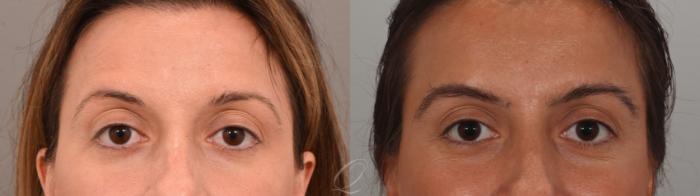 Eyebrow Hair Transplant Case 1001894 Before & After Front | Serving Rochester, Syracuse & Buffalo, NY | Quatela Center for Plastic Surgery