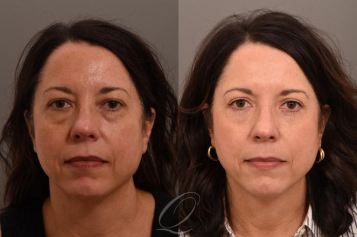 Eyelid Lift Case 1001861 Before & After Front | Serving Rochester, Syracuse & Buffalo, NY | Quatela Center for Plastic Surgery