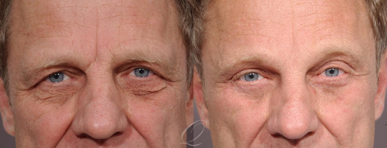 Eyelid Lift Case 1267 Before & After View #1 | Serving Rochester, Syracuse & Buffalo, NY | Quatela Center for Plastic Surgery