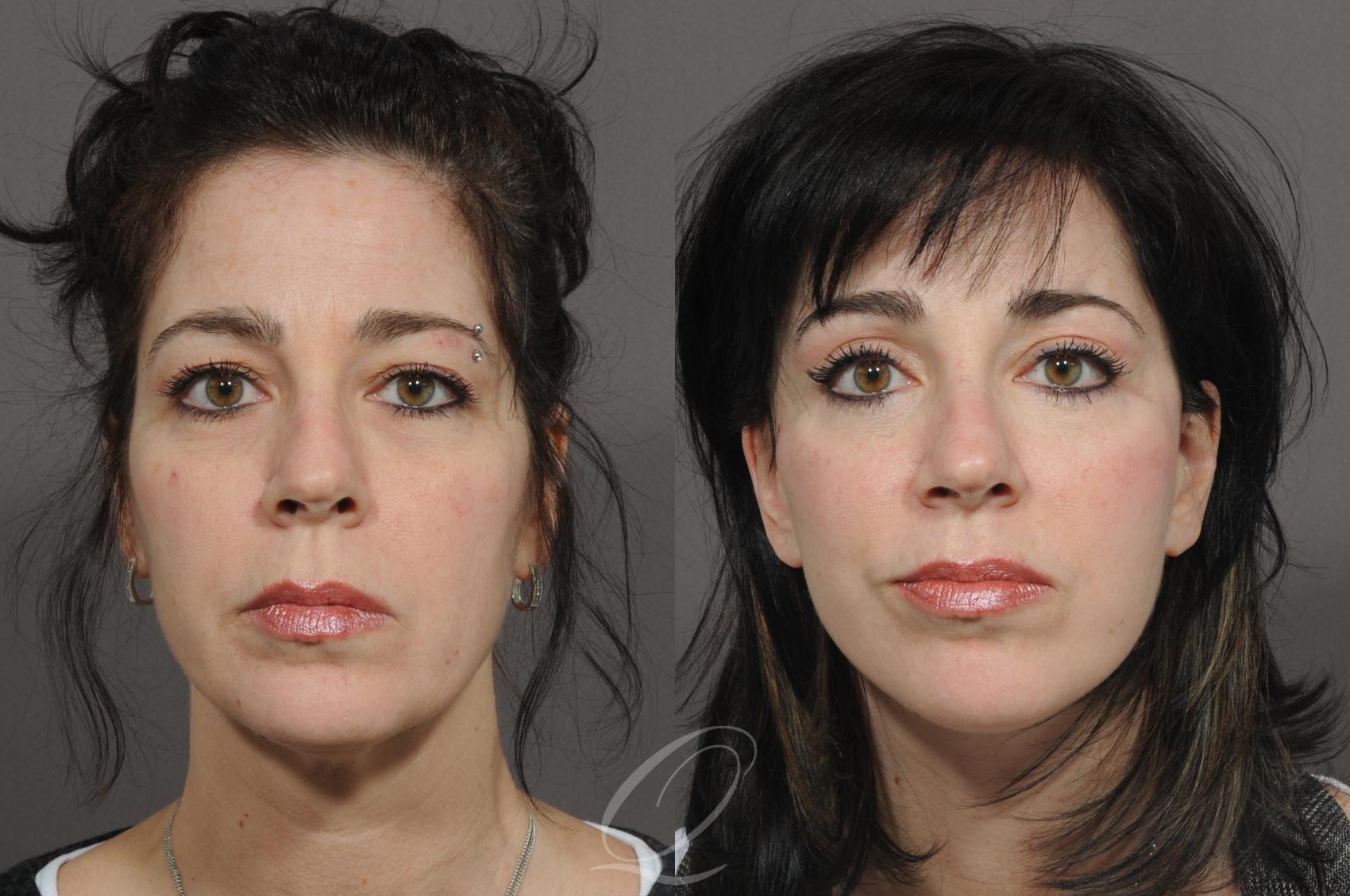 Eyelid Lift Case 74 Before & After View #1 | Rochester, NY | Quatela Center for Plastic Surgery