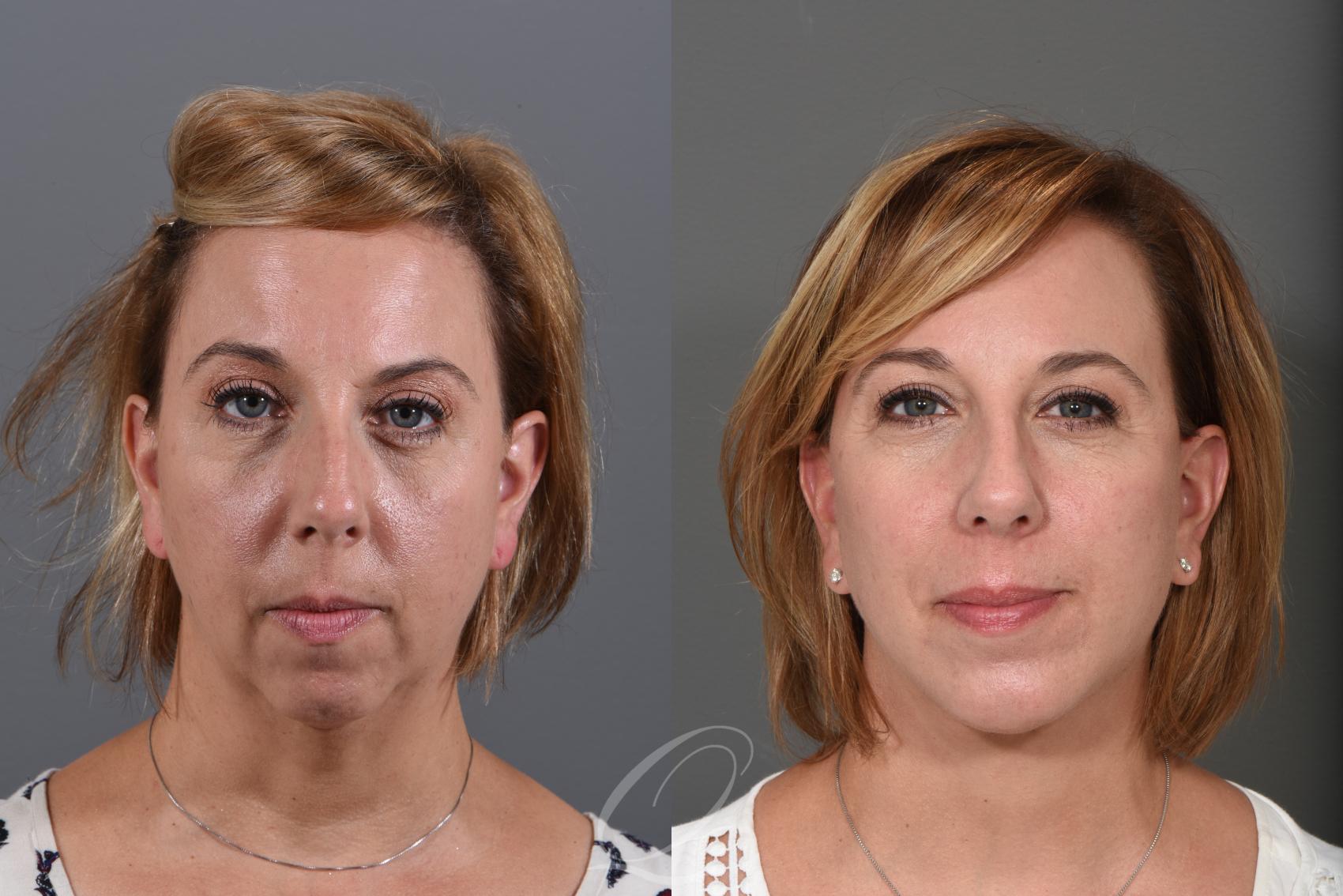 Facelift Case 1001249 Before & After View #1 | Rochester, NY | Quatela Center for Plastic Surgery