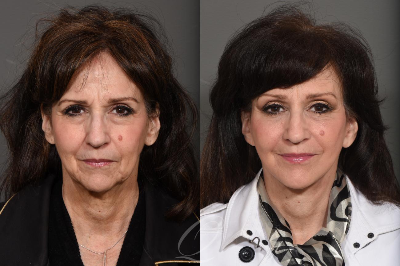 Brow Lift Case 1001263 Before & After View #1 | Rochester, NY | Quatela Center for Plastic Surgery