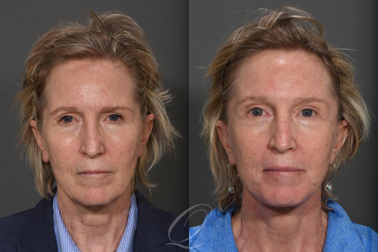 Brow Lift Case 1001266 Before & After View #1 | Serving Rochester, Syracuse & Buffalo, NY | Quatela Center for Plastic Surgery