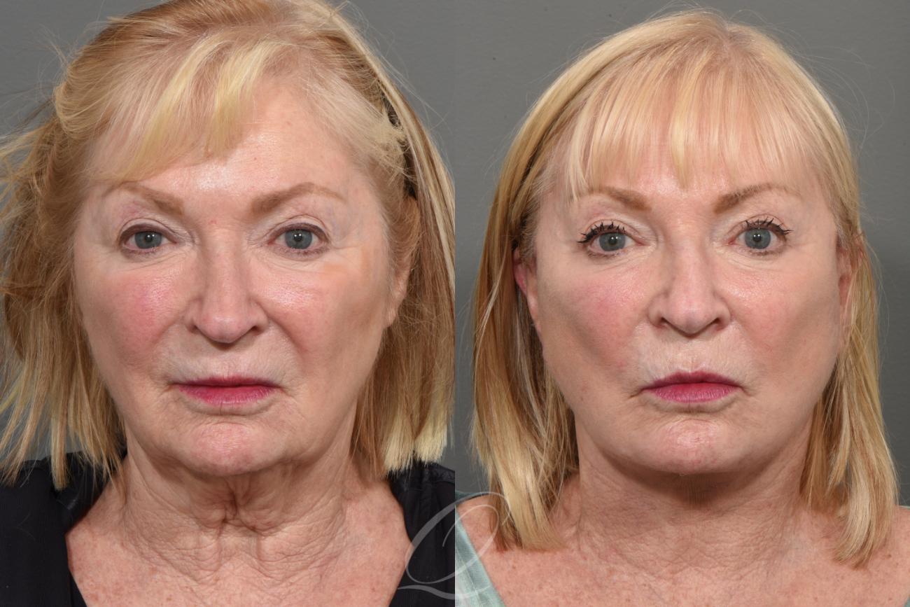 Brow Lift Case 1001338 Before & After Front | Serving Rochester, Syracuse & Buffalo, NY | Quatela Center for Plastic Surgery