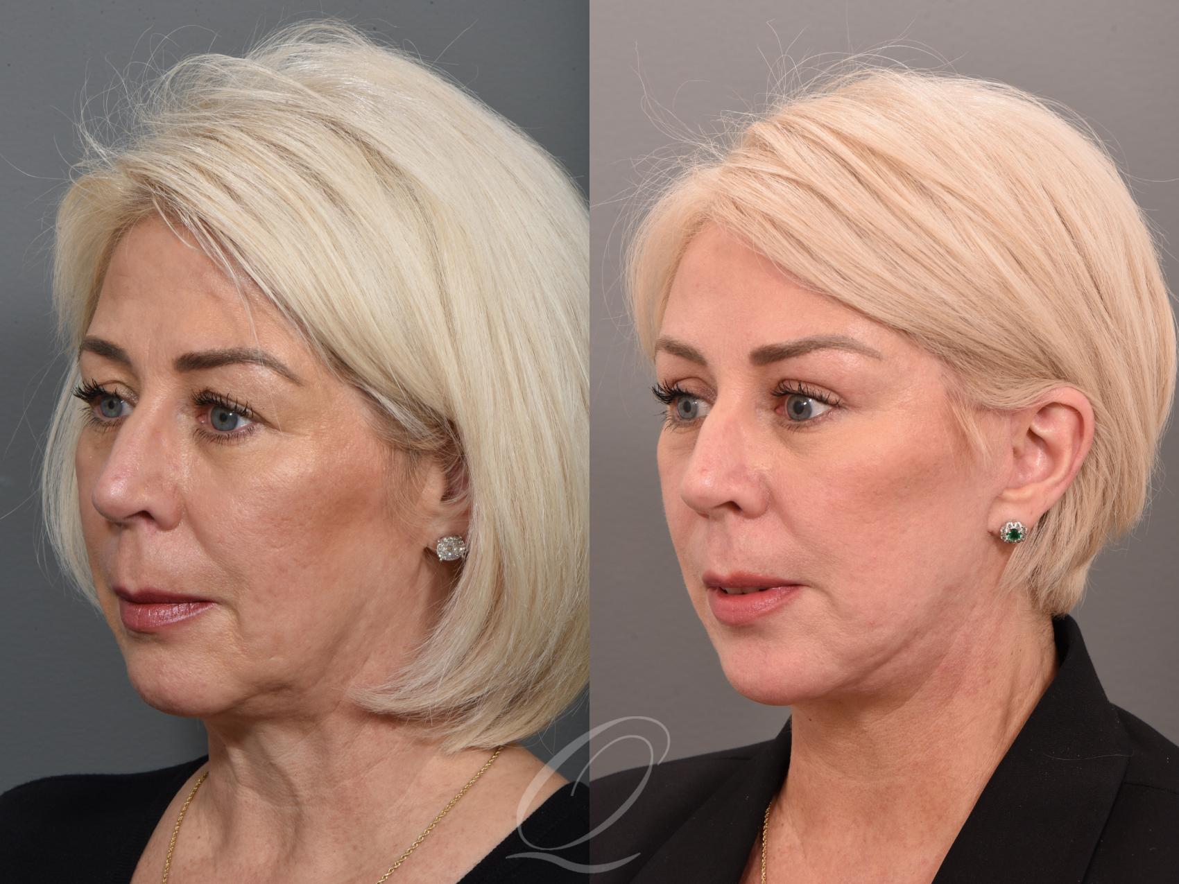 Facelift Case 1001509 Before & After Left Oblique | Serving Rochester, Syracuse & Buffalo, NY | Quatela Center for Plastic Surgery
