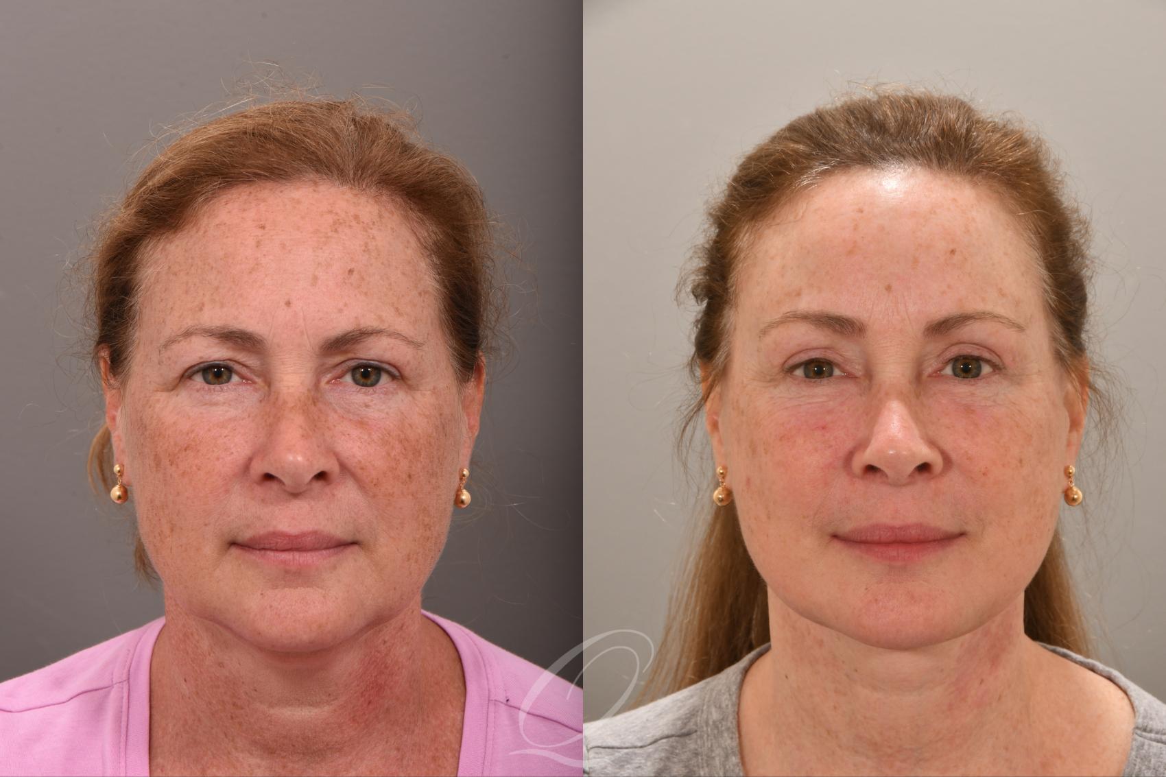 Facelift Case 1001664 Before & After Front | Serving Rochester, Syracuse & Buffalo, NY | Quatela Center for Plastic Surgery