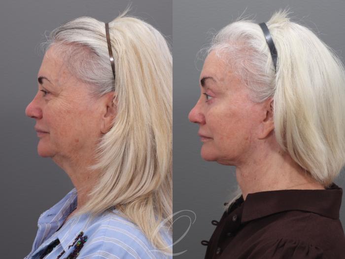 Brow Lift Case 1002003 Before & After Right Side | Serving Rochester, Syracuse & Buffalo, NY | Quatela Center for Plastic Surgery
