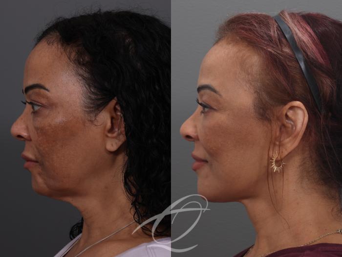 Fat Injections Case 1002033 Before & After Left Side | Serving Rochester, Syracuse & Buffalo, NY | Quatela Center for Plastic Surgery