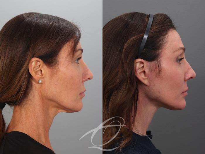 Fat Injections Case 1002078 Before & After Right Side | Serving Rochester, Syracuse & Buffalo, NY | Quatela Center for Plastic Surgery