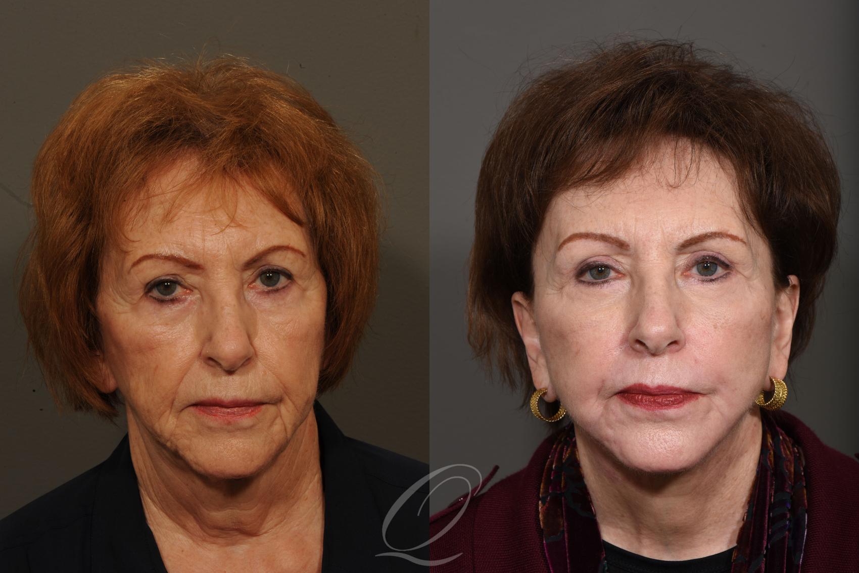 Facelift Case 1325 Before & After View #1 | Rochester, NY | Quatela Center for Plastic Surgery