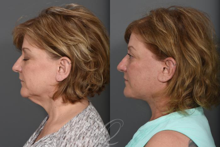 Facelift Case 1491 Before & After Left Side | Serving Rochester, Syracuse & Buffalo, NY | Quatela Center for Plastic Surgery