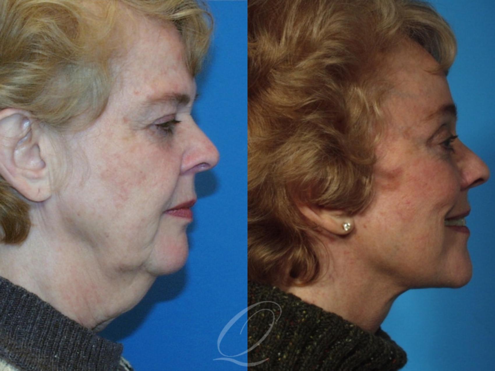 Facelift Case 209 Before & After View #3 | Serving Rochester, Syracuse & Buffalo, NY | Quatela Center for Plastic Surgery