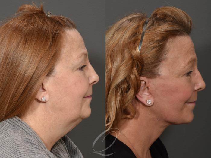 Neck Liposuction Case 335 Before & After View #3 | Serving Rochester, Syracuse & Buffalo, NY | Quatela Center for Plastic Surgery