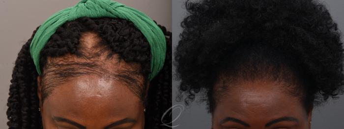 Before & After Female FUT Hair Transplant Case 1001914 Front View in Rochester, Buffalo, & Syracuse, NY