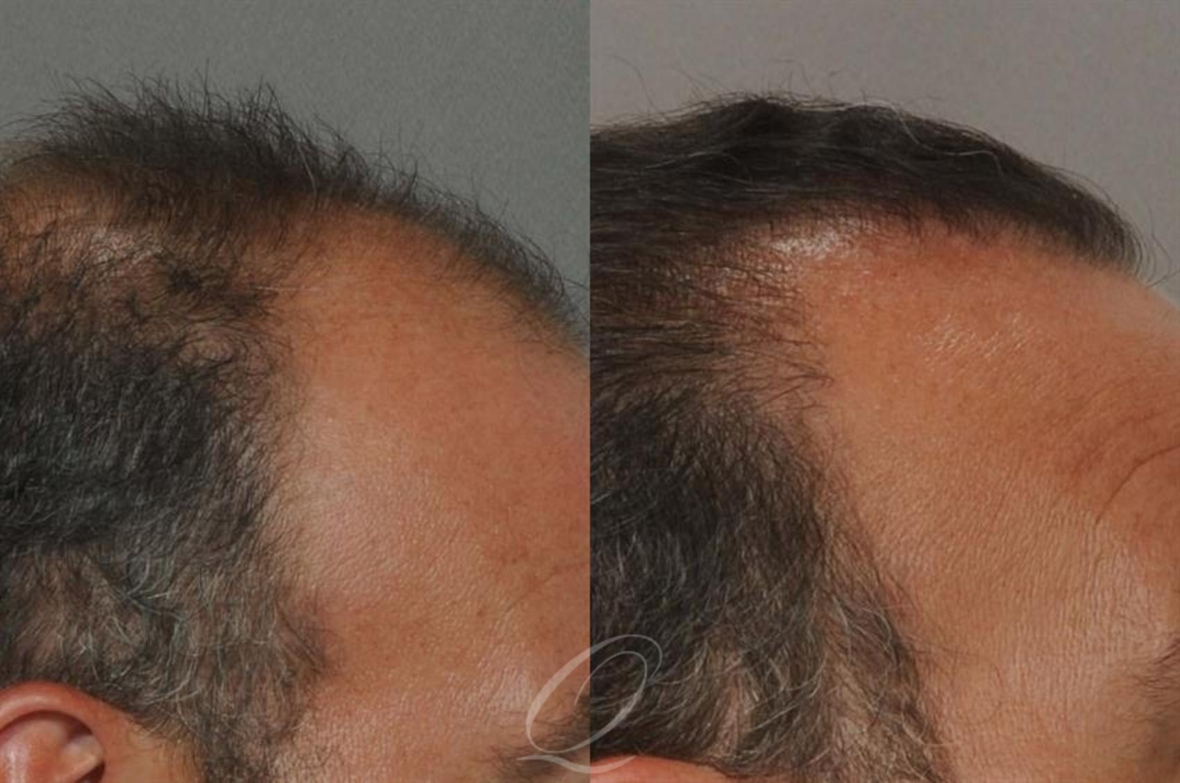 Fut Before After Photos Patient Rochester Ny Quatela Center