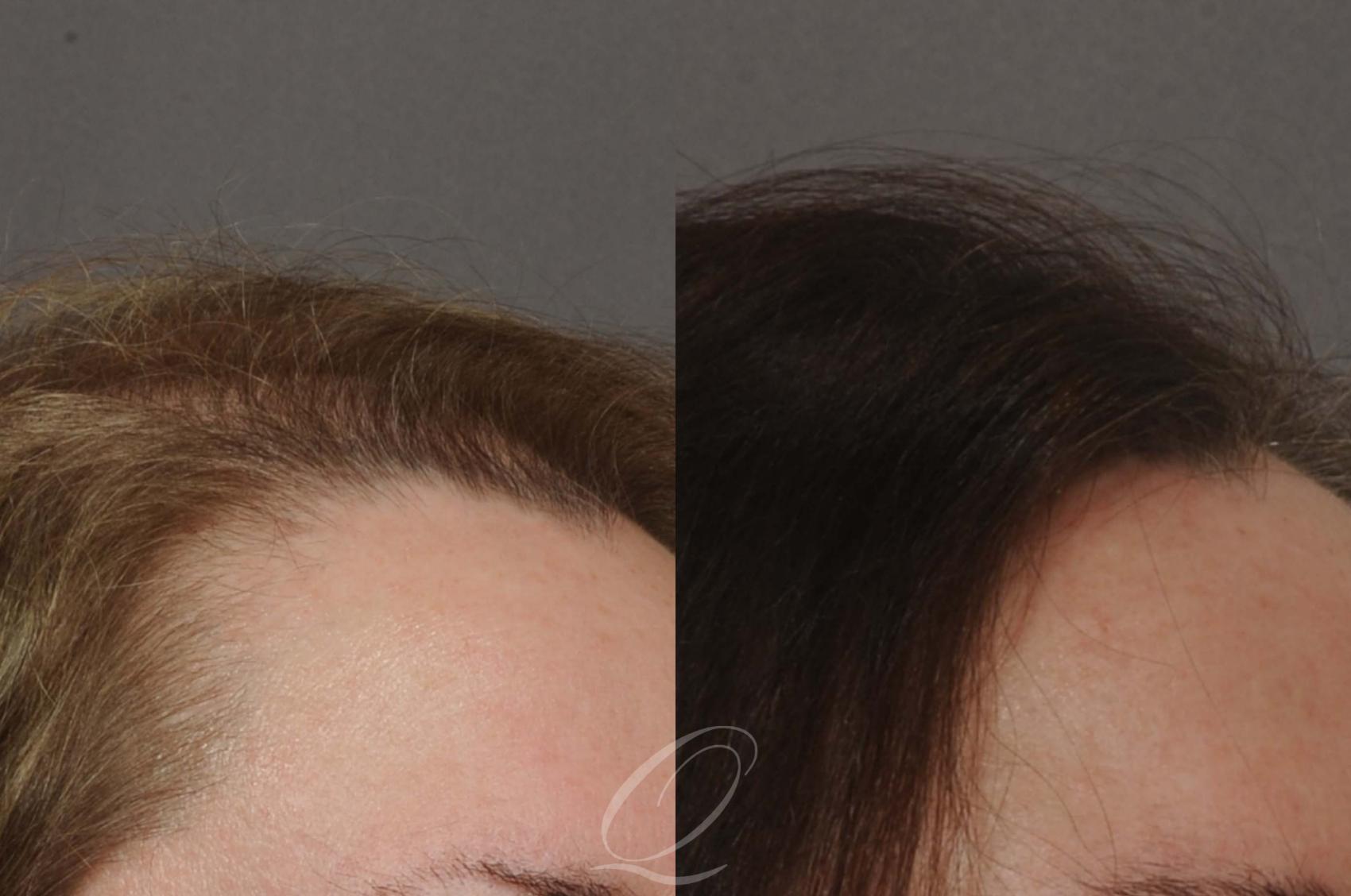 Fut Before After Photos Patient Rochester Buffalo Syracuse