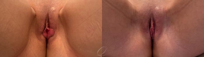 Labiaplasty Case 1001869 Before & After Front | Serving Rochester, Syracuse & Buffalo, NY | Quatela Center for Plastic Surgery