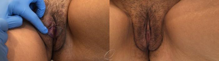 Labiaplasty Case 1001871 Before & After Front | Serving Rochester, Syracuse & Buffalo, NY | Quatela Center for Plastic Surgery