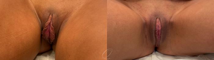 Labiaplasty Case 1001872 Before & After Front | Serving Rochester, Syracuse & Buffalo, NY | Quatela Center for Plastic Surgery