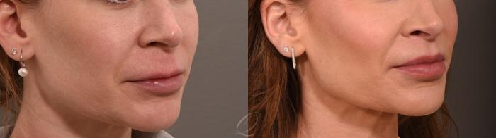 Lip Lift Case 1001864 Before & After Left Side | Serving Rochester, Syracuse & Buffalo, NY | Quatela Center for Plastic Surgery