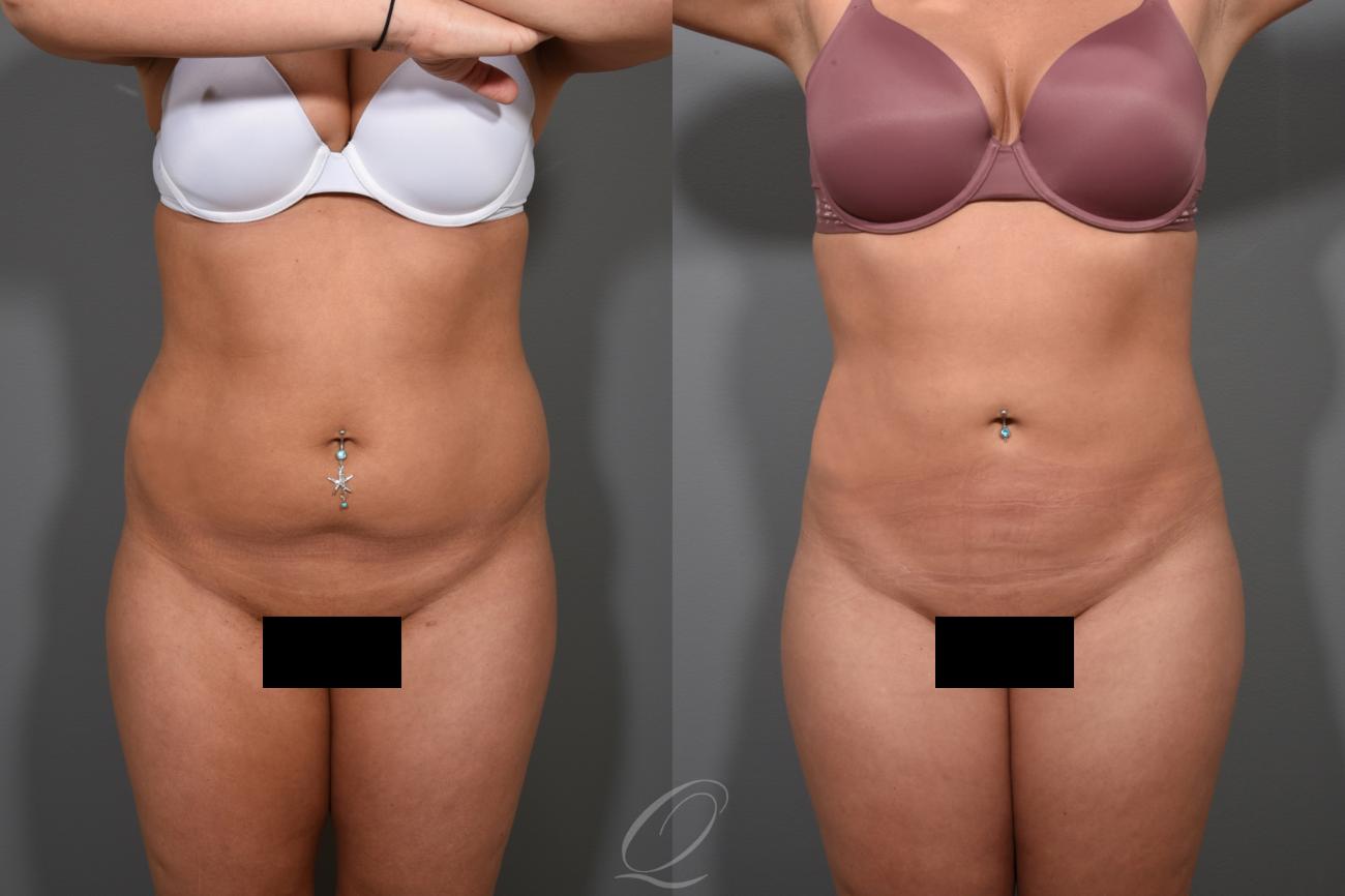 Liposuction Case 366 Before & After View #1 | Serving Rochester, Syracuse & Buffalo, NY | Quatela Center for Plastic Surgery