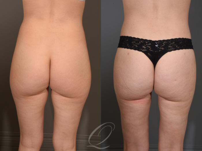 Liposuction Case 1001591 Before & After Back | Serving Rochester, Syracuse & Buffalo, NY | Quatela Center for Plastic Surgery