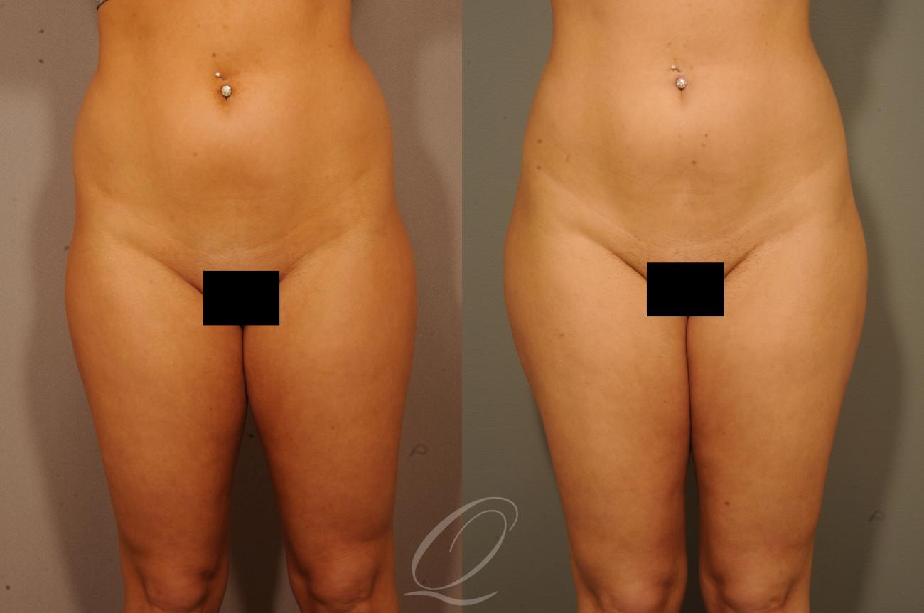 Liposuction Case 273 Before & After View #1 | Serving Rochester, Syracuse & Buffalo, NY | Quatela Center for Plastic Surgery