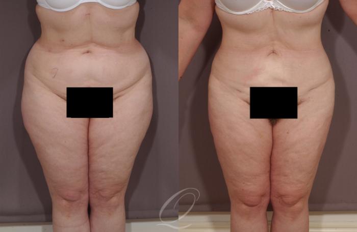Liposuction Case 85 Before & After View #1 | Serving Rochester, Syracuse & Buffalo, NY | Quatela Center for Plastic Surgery