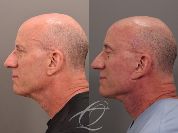 Facelift Case 1002049 Before & After Left Side | Serving Rochester, Syracuse & Buffalo, NY | Quatela Center for Plastic Surgery