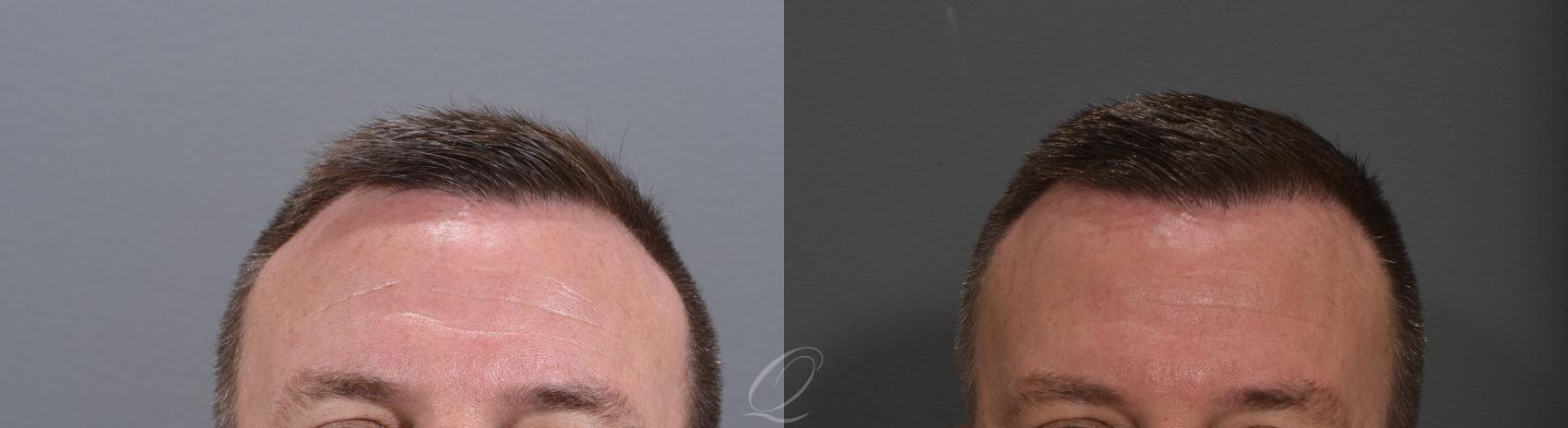 Scarless Hair Transplant In Rochester Ny Fue Quatela Center For