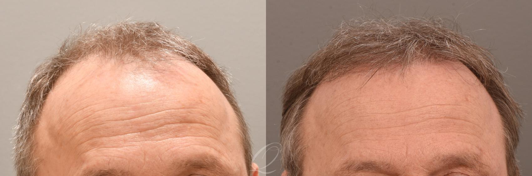 Before & After Male FUE Hair Transplant Case 1001883 Front View in Rochester, Buffalo, & Syracuse, NY