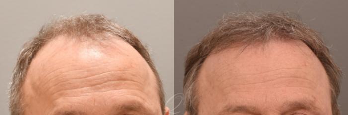Before & After Male FUE Hair Transplant Case 1001883 Front View in Rochester, Buffalo, & Syracuse, NY